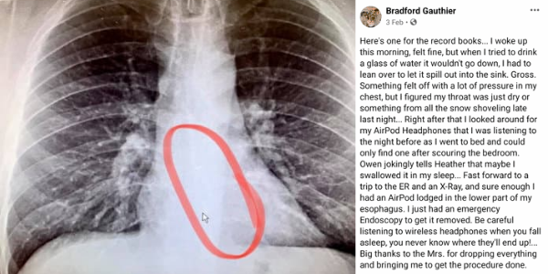Man Swallows Airpod While Sleeping- Undergoes Endoscopy