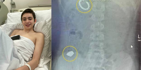Boy Swallows 54 Magnets to Become Magnetic- Undergoes Operation